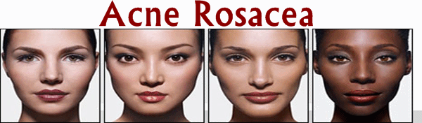 Acne Rosacea information source on Acne Rosacea!