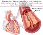 Arteriosclerosis heart disease heart-photo