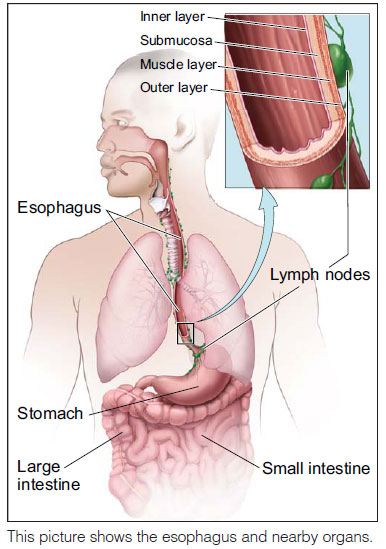cancer of the esophagu