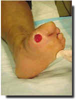 Charcot foot wounds are serious and require fast treatment