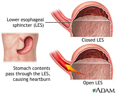Stomach content reflux causes heartburn and GERD