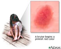 A young girls skin will nicely regrow easily bruised skin