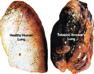 damaging and life threatening negative changes to lung condition attibutable to smoking