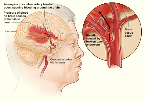 Illustration shows how a hemorrhagic stroke can occur in the brain. An aneurysm in a cerebral artery breaks open, which causes bleeding in the brain. The pressure of the blood causes brain tissue death.