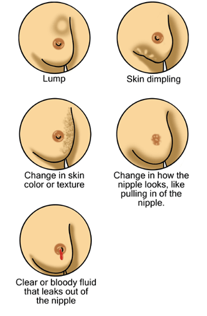 Changes to look for in the breasts