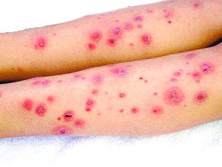 Herpes viral infection and other infections may come via cuts, abrasions, body contact, vaccination and other ways