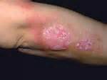 Psoriasis of the skin on back of lower arm and elbow