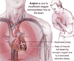 Congestive heart-failure also known as angina drawings
