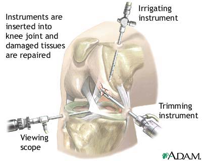 Courtesy Arthroscopic Surgery Surgical knee Viewing scope Irrigating; Trimming Instruments picture