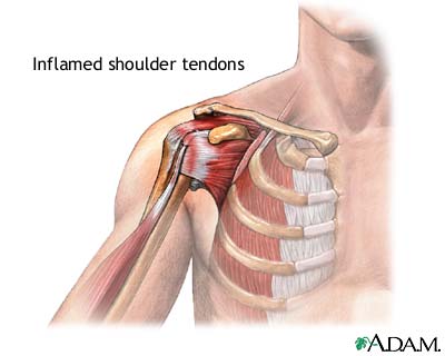 Picture of inflamed shouder tendons