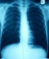 Notice how left lung looks more damaged vs right on emphysema x-ray