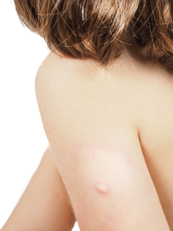 Spinal Meningitis causing mosquito bite on childs arm