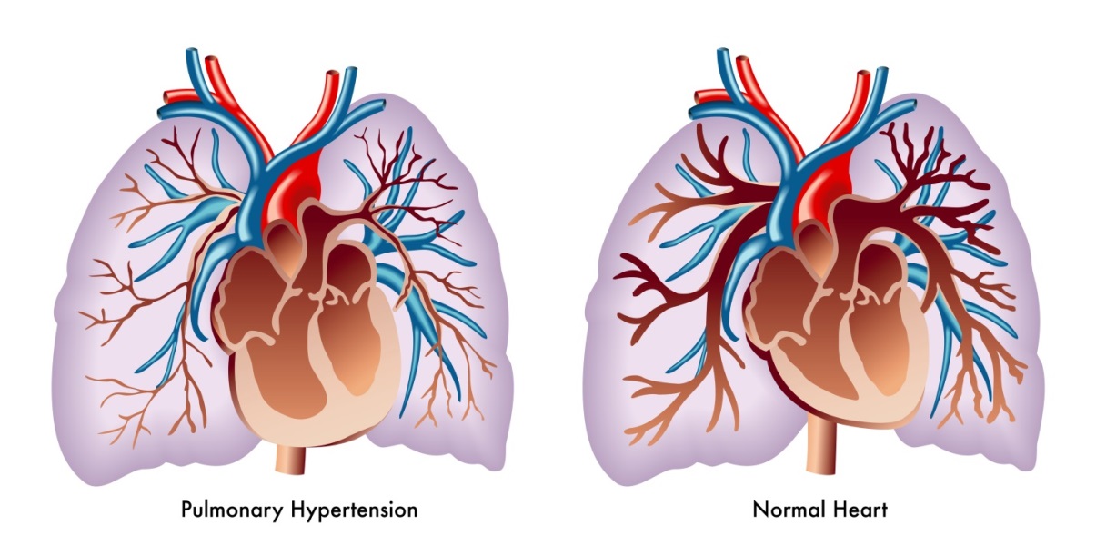 pulmonary-hypertension pictures normal vs abnormal