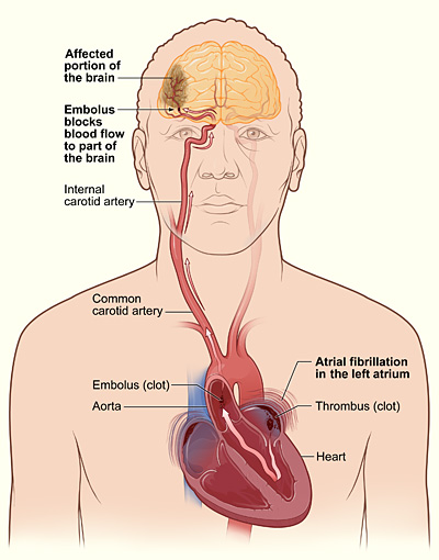 The illustration shows how a stroke can occur during atrial fibrillation. If a clot (thrombus) forms in the left atrium of the heart, a piece of it can dislodge and travel to an artery in the brain, blocking blood flow through the artery. The lack of blood flow to the portion of the brain fed by the artery causes a stroke.