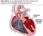 Atherosclerosis a.k.a. Arteriosclerosis human heart drawing