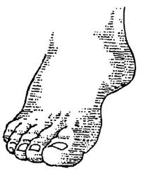 Charcot foot problems can lead to serious complications without proper treatment