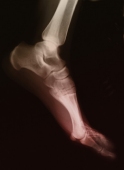 gout developes in joints