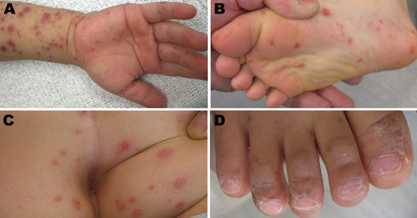 Sores commonly appearing