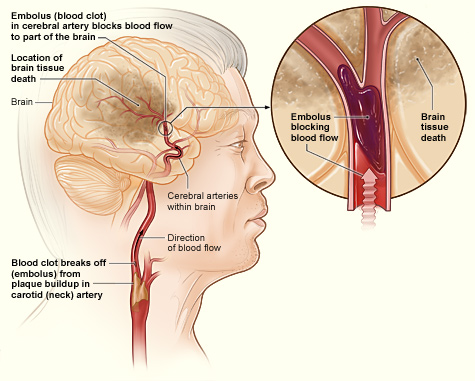 illustration shows how an ischemic stroke can occur in the brain. If a blood clot breaks away from plaque buildup in a carotid (neck) artery, it can travel to and lodge in an artery in the brain. The clot can block blood flow to part of the brain, causing brain tissue death.